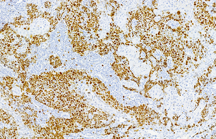Targeted Gene Panel for Tumor Analysis